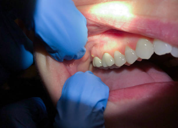 Best Emergency Gum Treatment in Underwood, IA